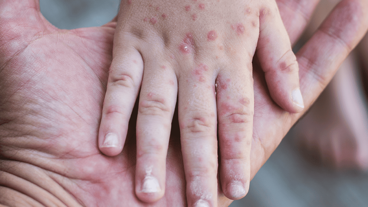 measles cases rise canada