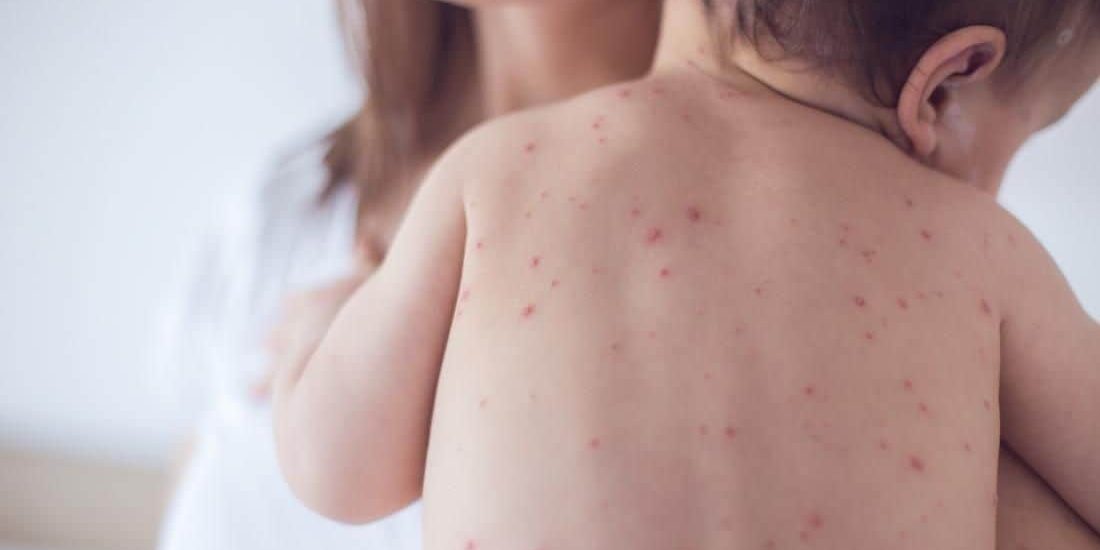 Unimmunized child with measles may have exposed others to virus in Ontario