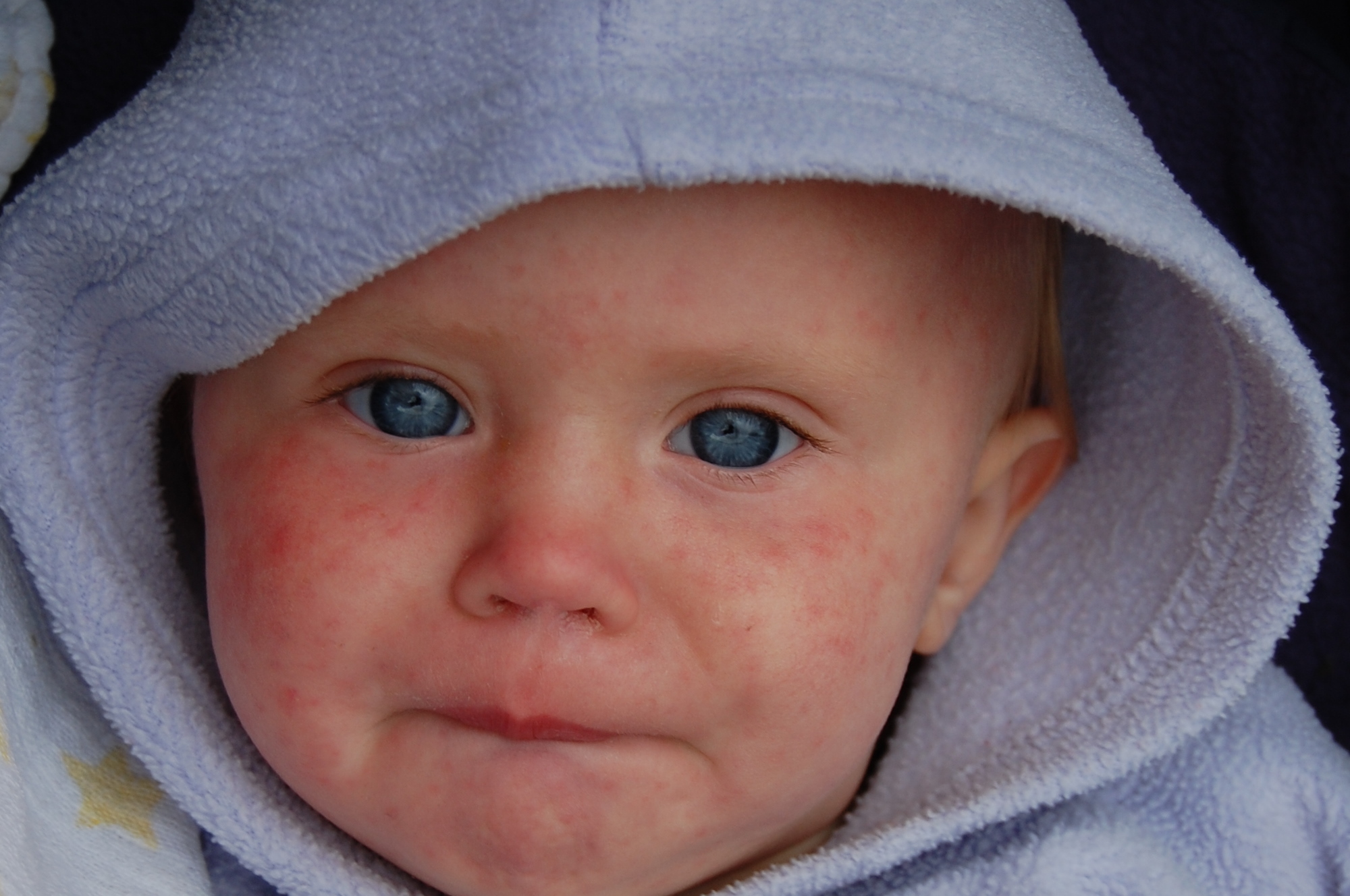measles on the rise in ontario mississauga brampton peel
