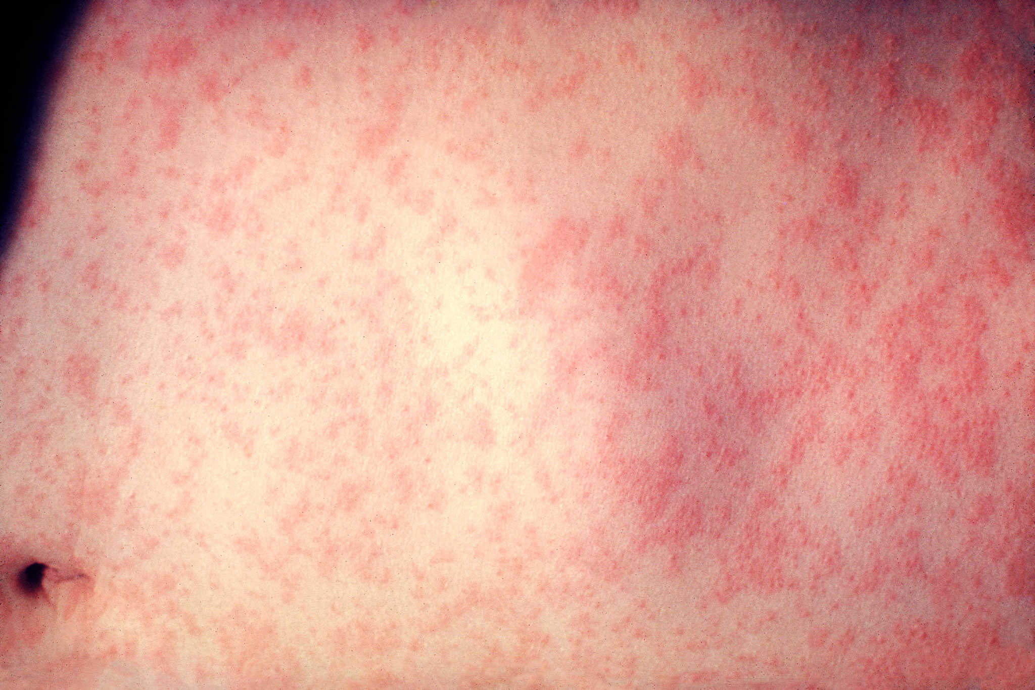 measles pearson airport mississauga toronto ontario